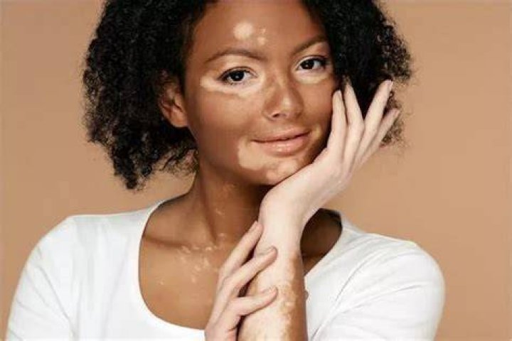 Are all white patches vitiligo?