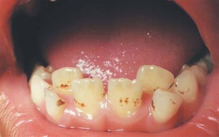 Are brown dots on teeth cavities?