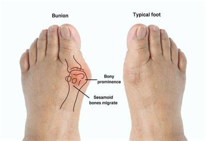 Are bunions arthritis?