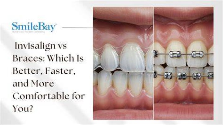 Are clear aligners better than braces?