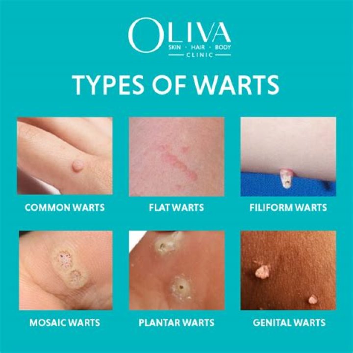 Are common warts an STD?