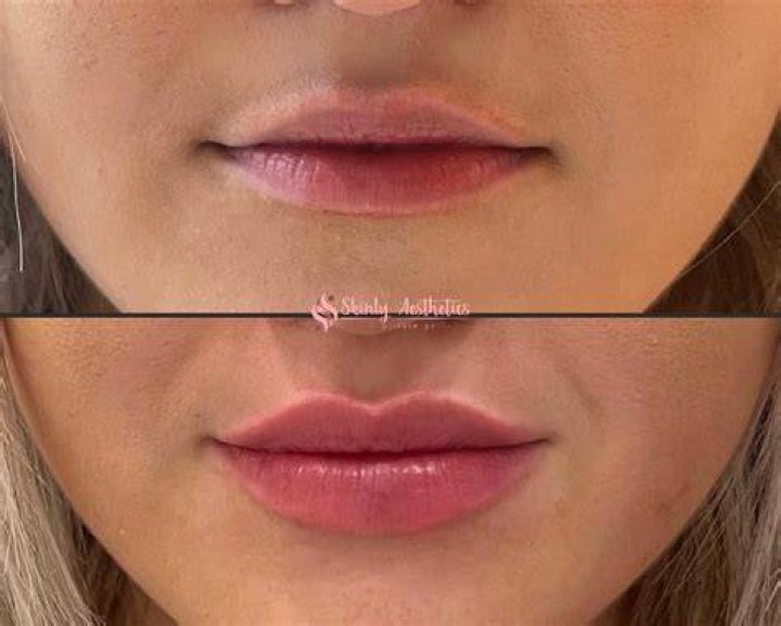 Are lip fillers still popular?