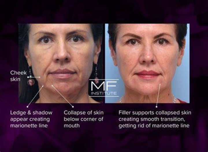Are marionette lines genetic?