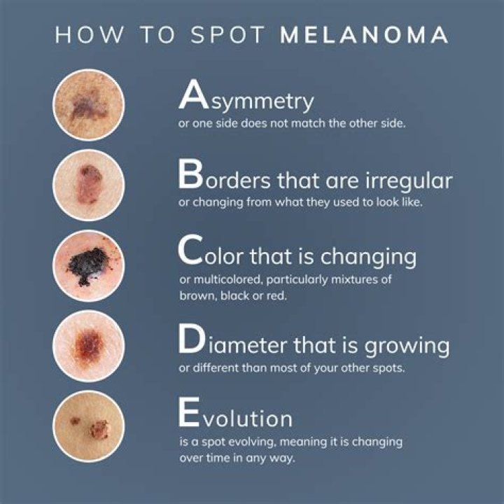 Are melanomas always black?