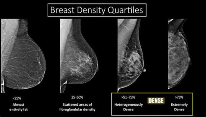 Are small breasts more likely to be dense?