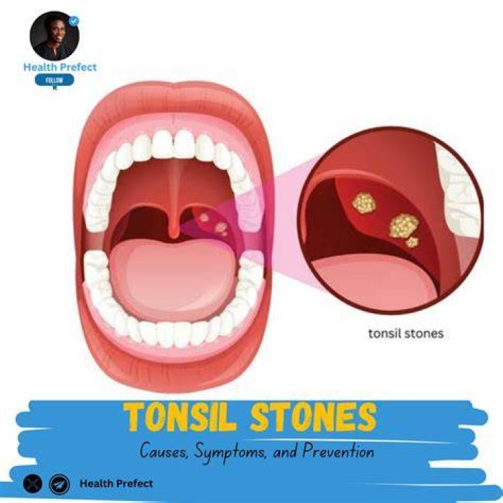 Are tonsil stones harmless?