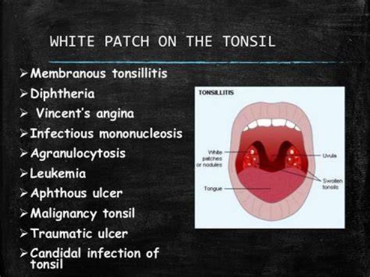 Are tonsils white with mono?