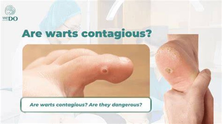Are warts contagious if you touch them?