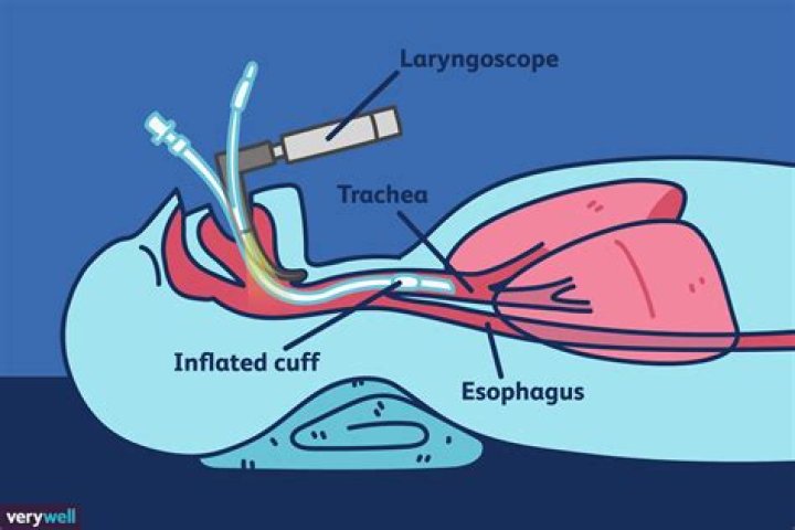 Are you intubated during oral surgery?