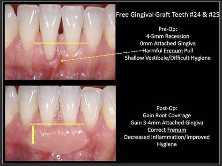 Are you put under for gum graft?