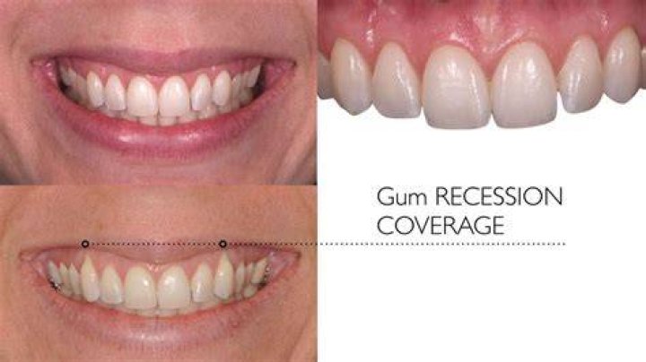 At what age do people get gum grafts?