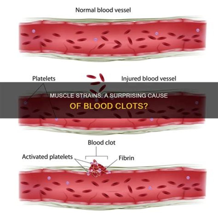 Can a blood clot cause fatigue?