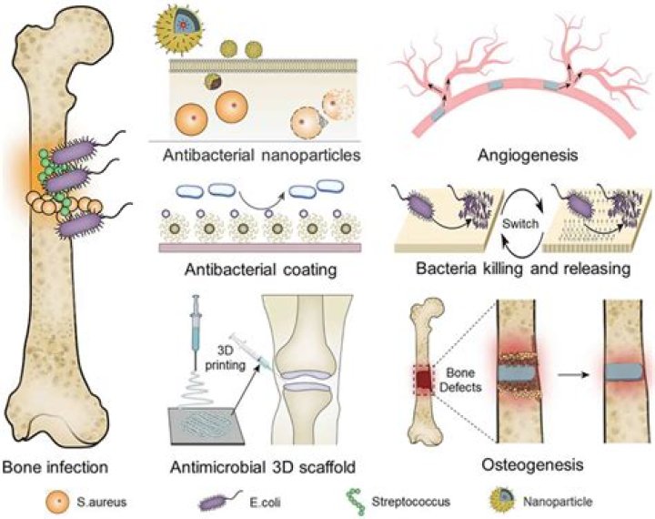 Can a bone infection be cured?
