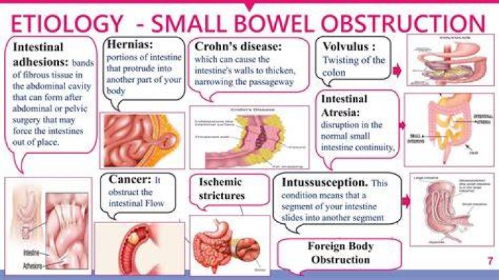 Can a bowel obstruction clear on its own?