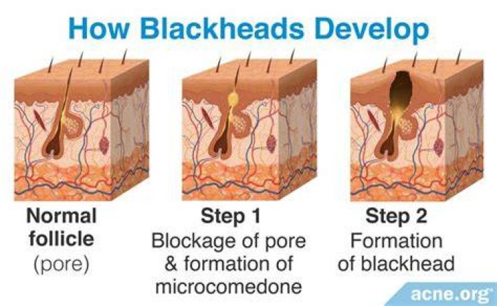 Can a child get blackheads?