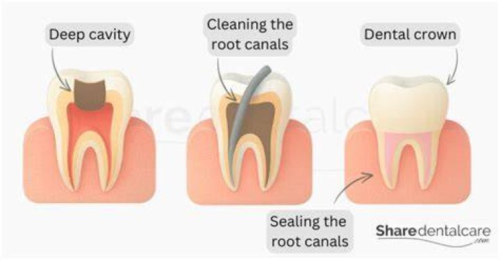 Can a crown replace a root canal?