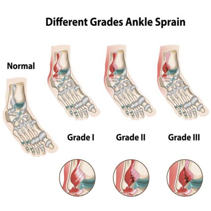 Can a grade 3 ankle sprain heal without surgery?