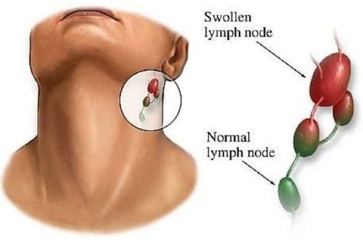 Can a hard lymph node be benign?