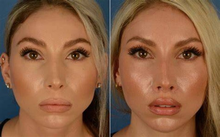 Can a lip lift Change your nose?