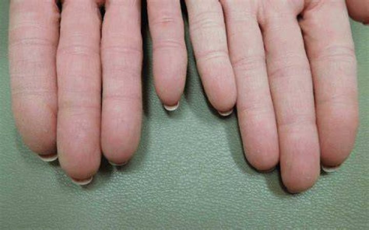 Can a person have no fingerprints?