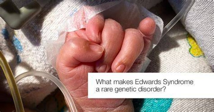 Can a person with Edwards syndrome have a baby?