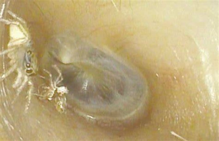 Can a spider go into your ear?