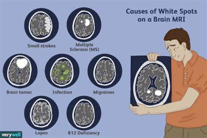 Can a spot on an MRI be nothing?