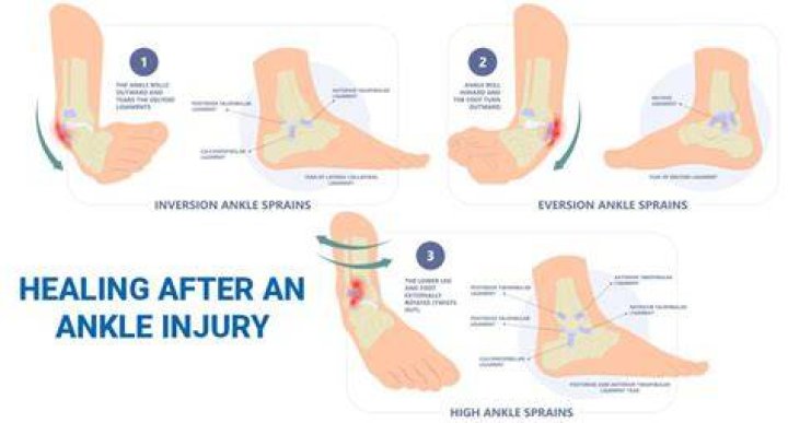 Can a sprained ankle last forever?