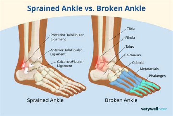 Can a sprained foot get worse?