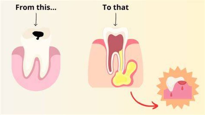 Can a tooth abscess heal on its own?