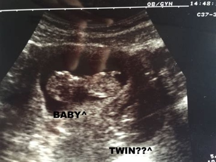 Can a twin hide behind the other in an ultrasound?