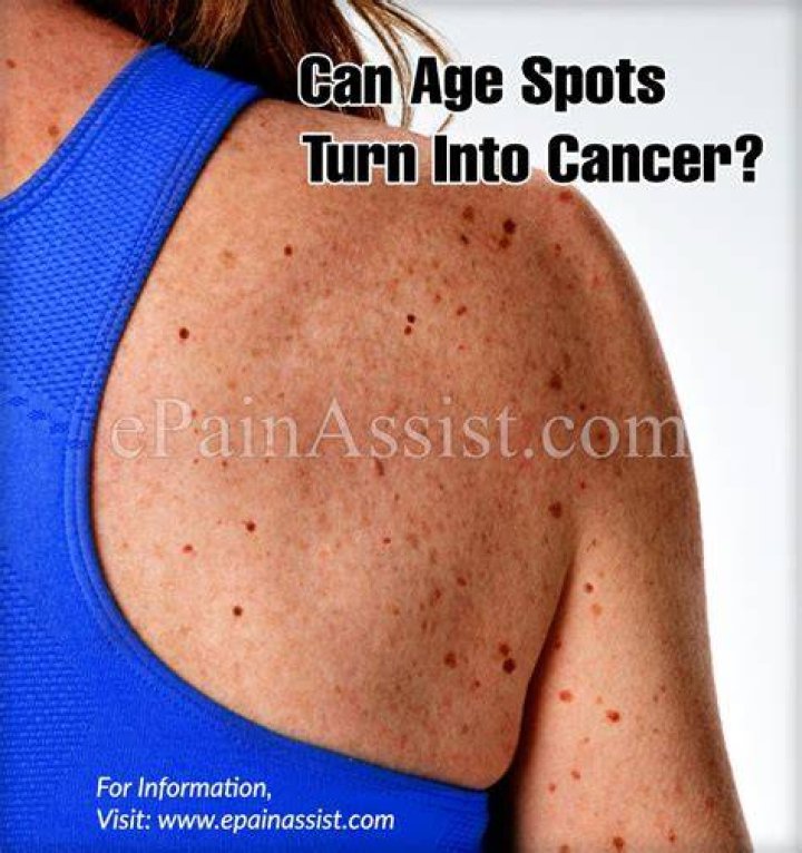 Can age spots turn into cancer?