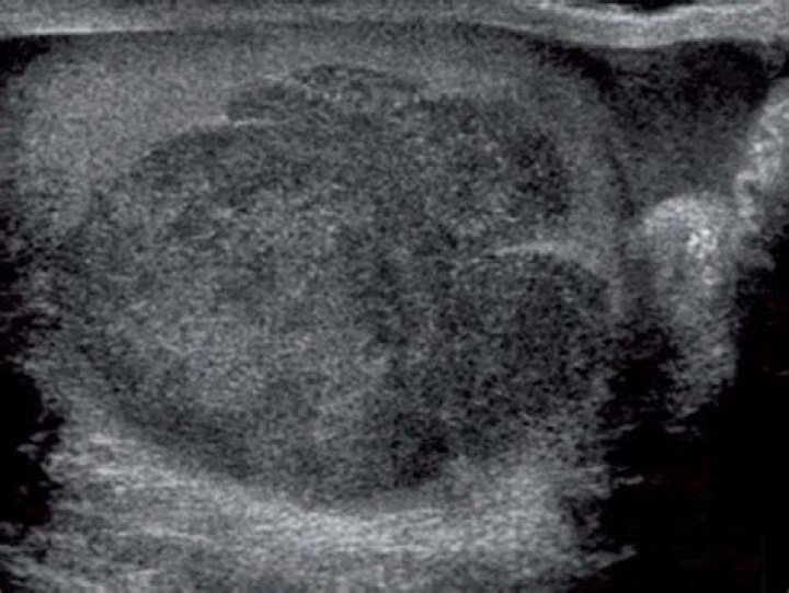 Can an ultrasound miss a tumor?