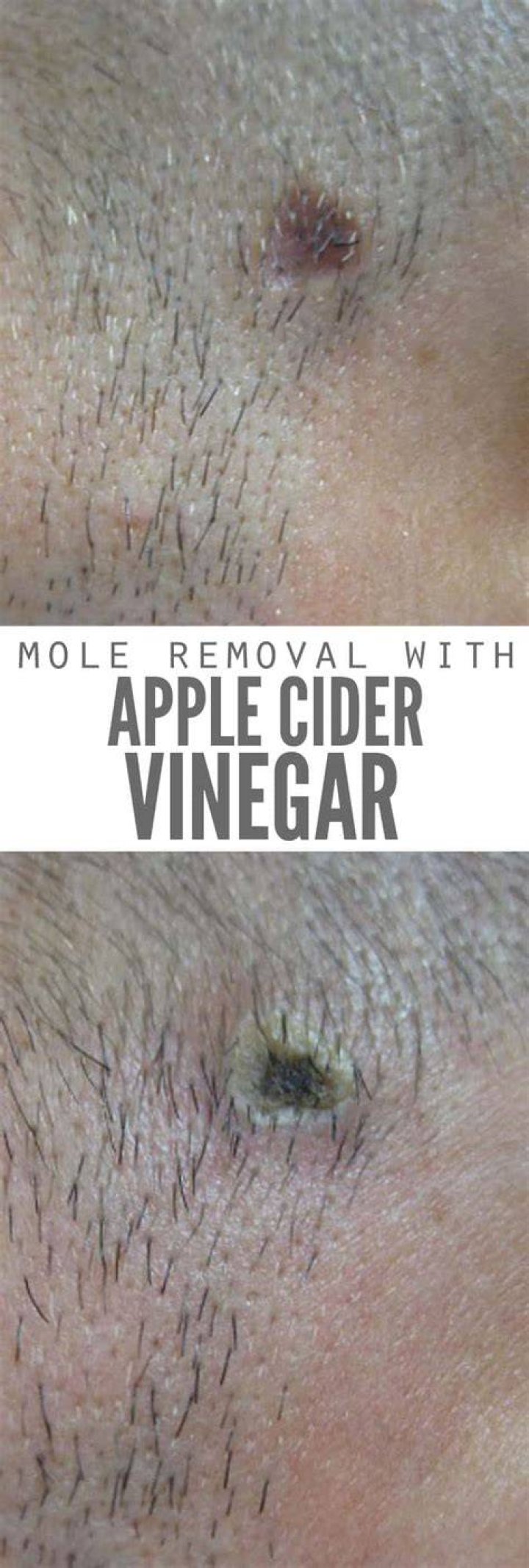 Can Apple cider vinegar remove moles?