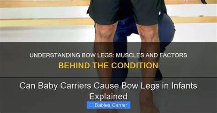 Can baby walkers cause bow legs?