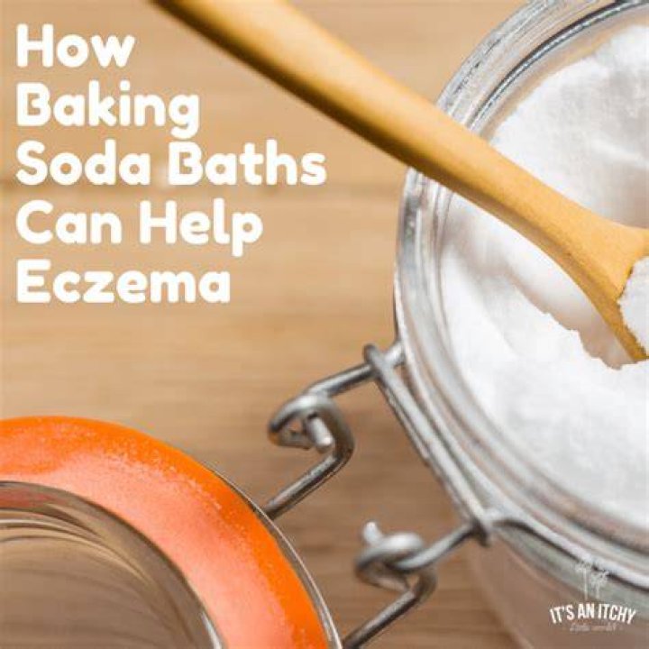 Can baking soda help eczema?