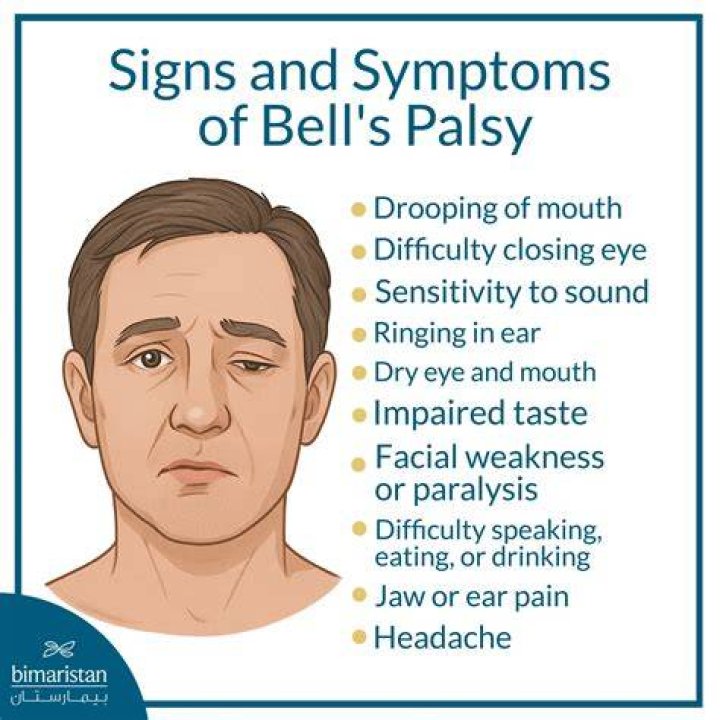 Can Bell's Palsy turn into something else?