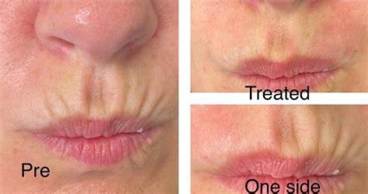Can big lips be reduced?