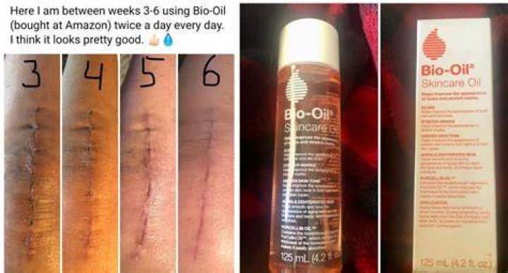 Can Bio-Oil make scars worse?
