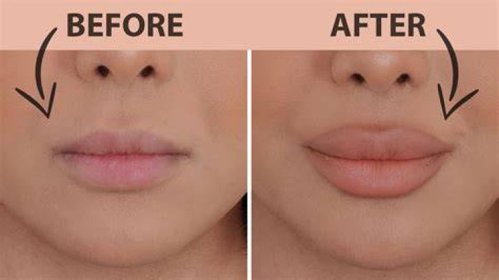 Can Botox make your lips bigger?