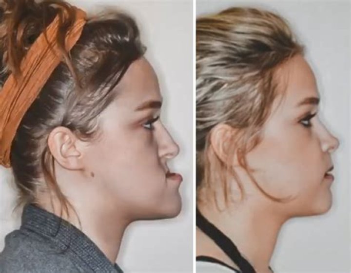 Can braces change your jawline?