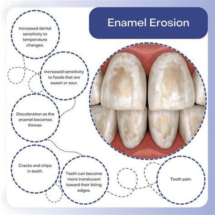 Can braces destroy enamel?