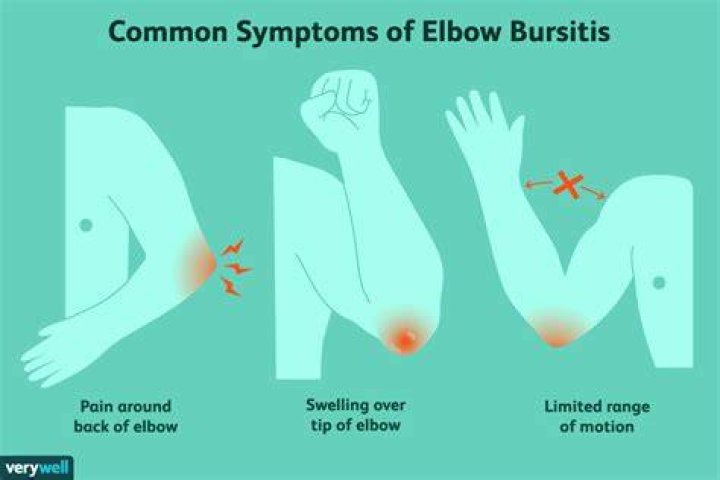 Can bursitis last for years?