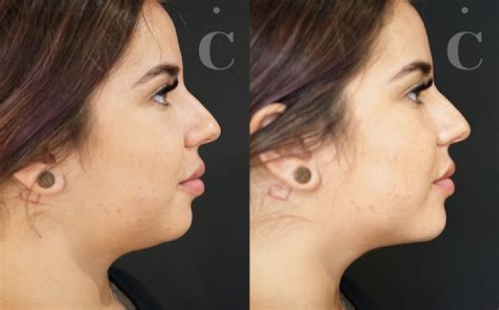 Can chin filler migrate to double chin?