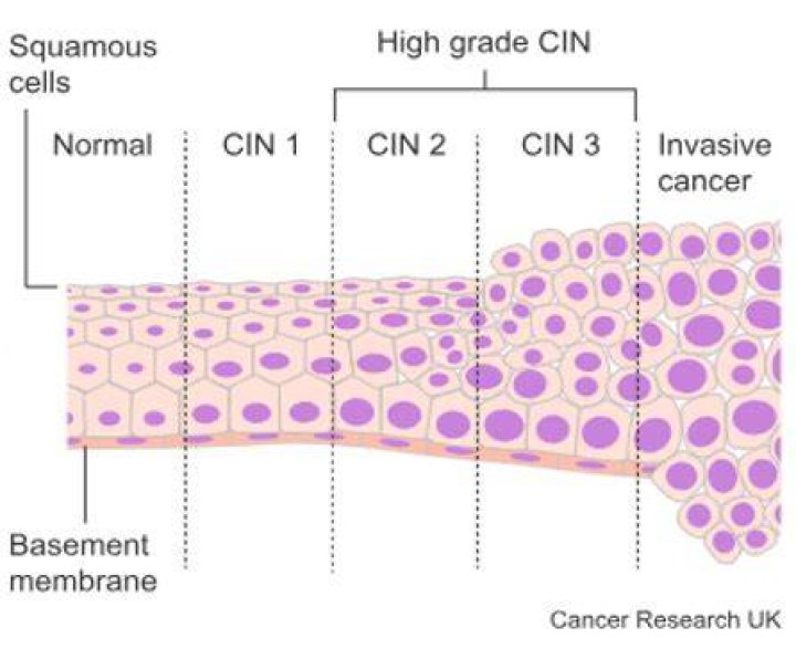 Can CIN 3 Be Cured?
