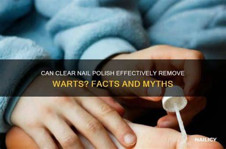 Can clear nail polish get rid of warts?