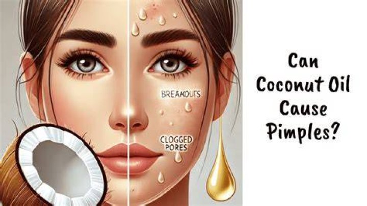 Can coconut oil cause pimples?