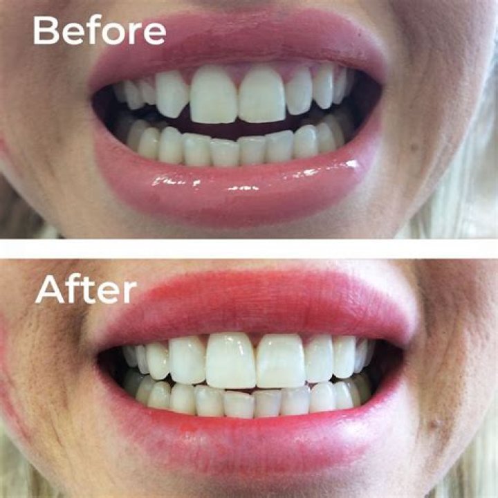 Can composite bonding be whitened?