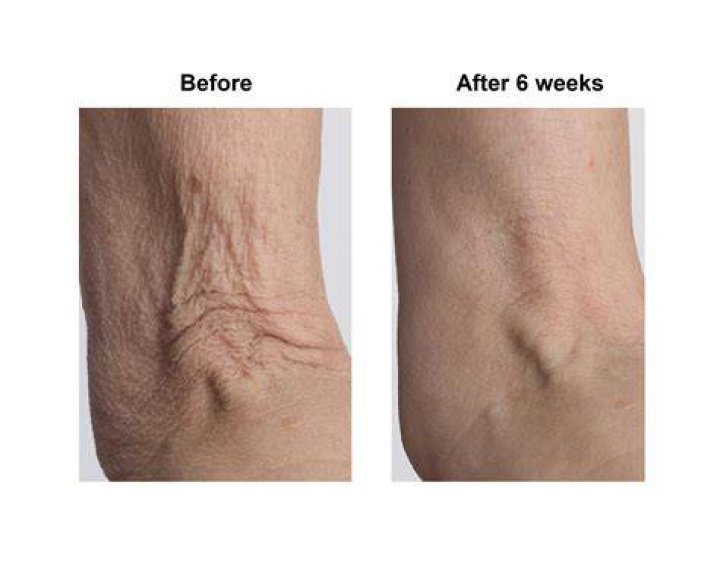 Can Crepey skin be tightened?