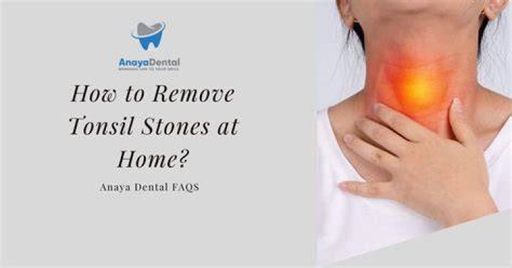 Can dentists remove tonsil stones?